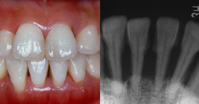 歯周病の写真1