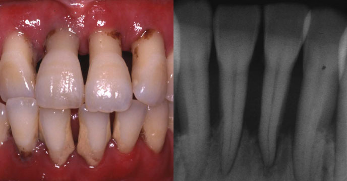 歯周病の写真2