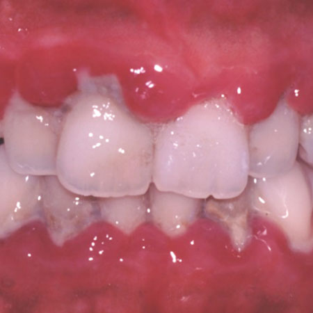 歯周病の歯の図