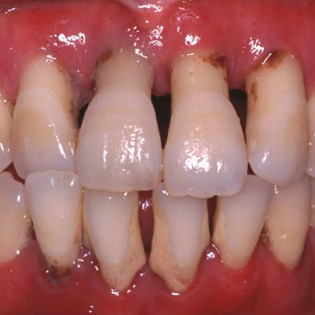 歯周病進行の図